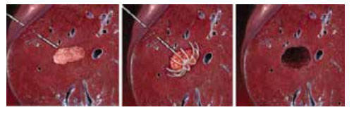 Hủy u gan qua da bằng sóng cao tần - Bệnh Viện FV