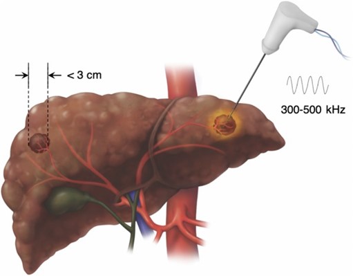 Đốt sóng cao tần u gan - BS Toàn
