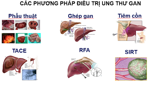 Ung thư gan có chữa khỏi được không?