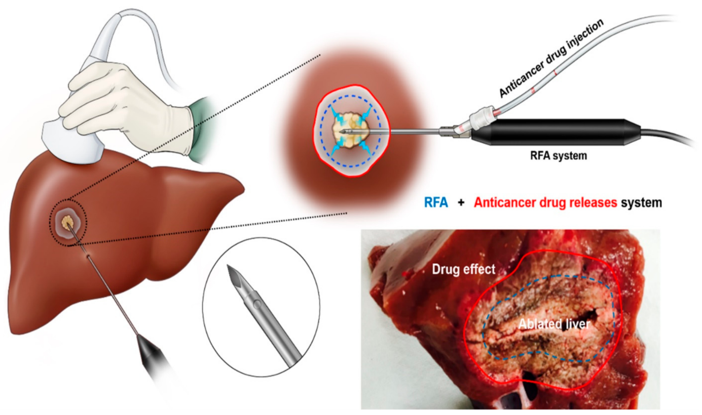 Đốt sóng cao tần (RFA) điều trị ung thư gan - Bác sĩ Toàn