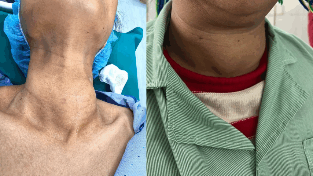 u tuyến giáp to gây lồi cổ gây ra nhiều biến chứng như khó thở, nuốt vướng