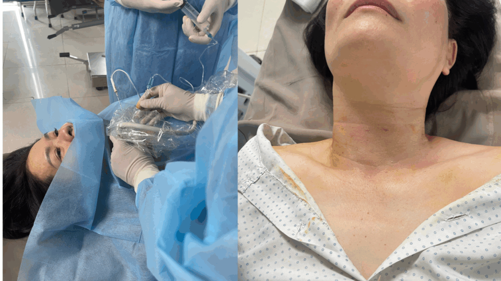 Kỹ thuật đốt tốt sẽ ảnh hưởng rất nhiều đến vết tích khối u tuyến giáp sau đốt sóng cao tần RFA