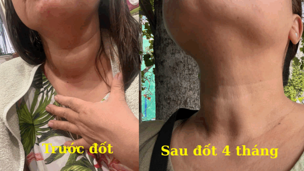 Khối u tuyến giáp trước và sau khi đốt khoảng 4 tháng