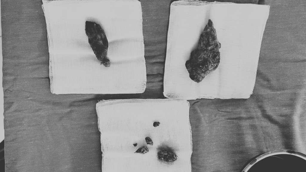 U tuyến giáp khi được phẫu thuật lấy ra