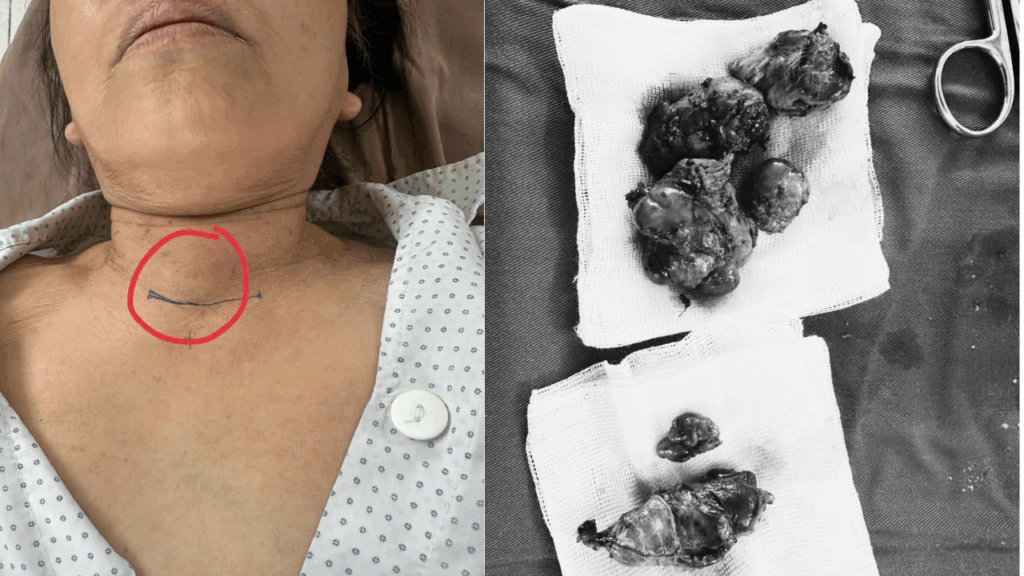 Bóc tách u tuyến giáp ảnh to vẫn giữ lại được tuyến cận giáp và không ảnh hưởng các dây thân kinh liên quan